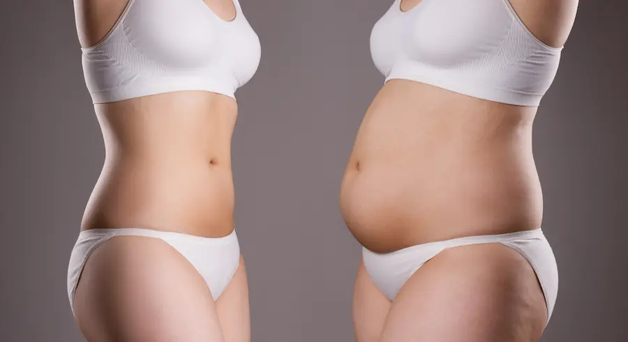 360 Lipo Before and After