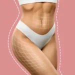 360 Liposuction
