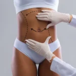 Abdomen Liposuction