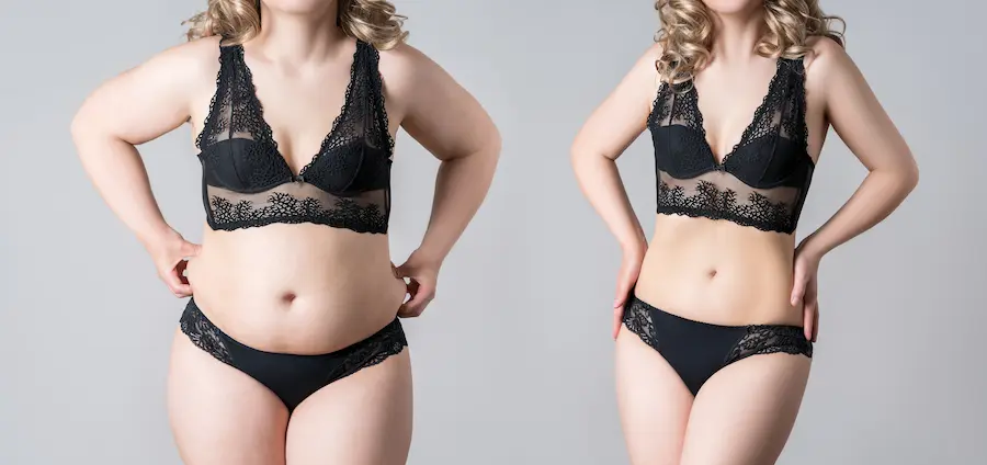 Abdomen Liposuction Before and After