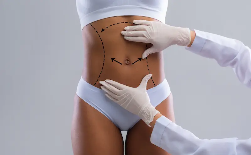 Abdomen Liposuction