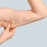 Arm Liposuction