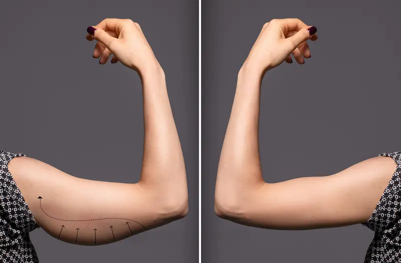 Arm Liposuction in Turkey