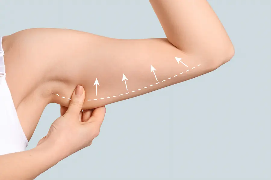 Arm Liposuction