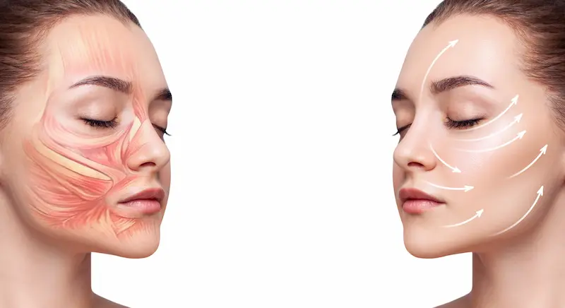 Deep Plane Face Lift