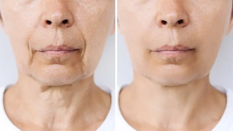Facelift Surgery Before and After