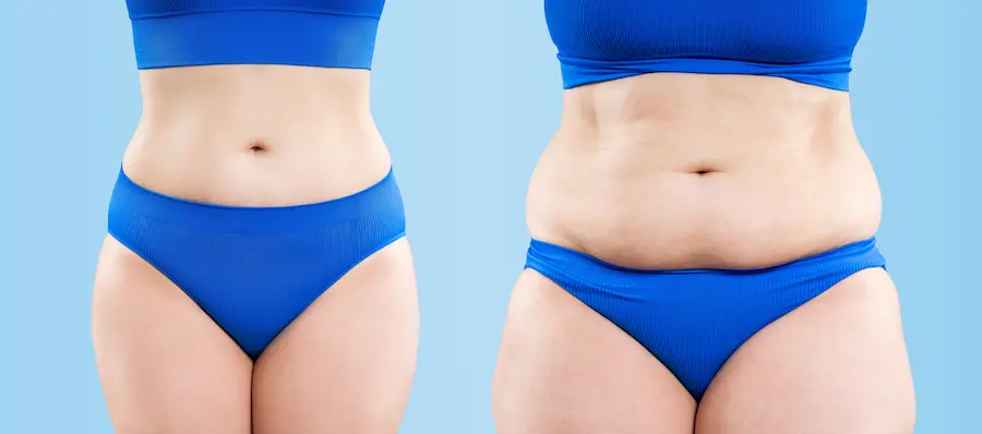 Before and After: HD Lipo Transformations