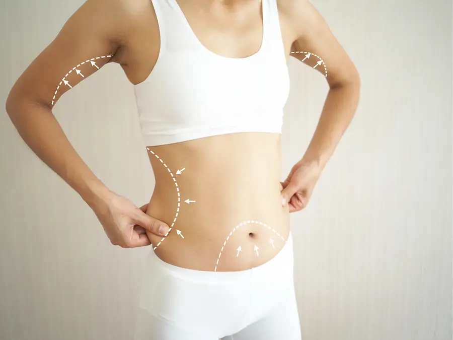 Laser Liposuction in Turkey