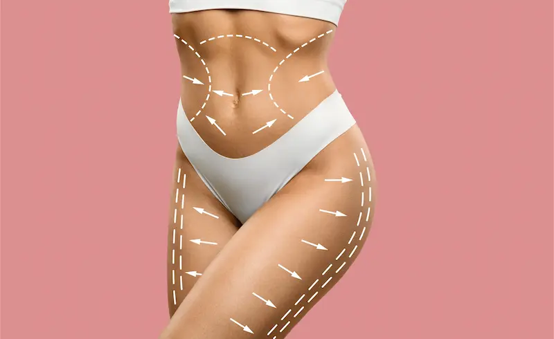 Liposuction Procedure in Turkey