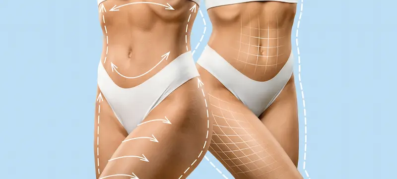 Liposuction