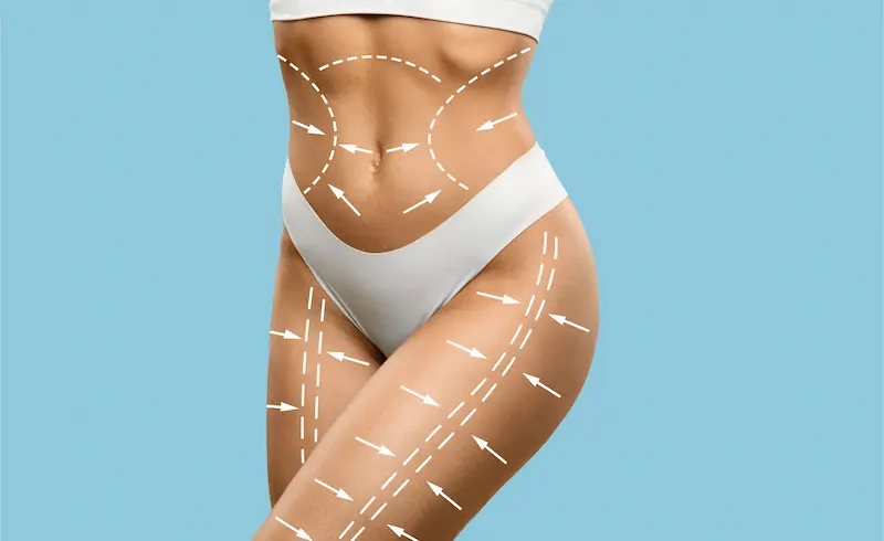 Target Areas for Liposuction