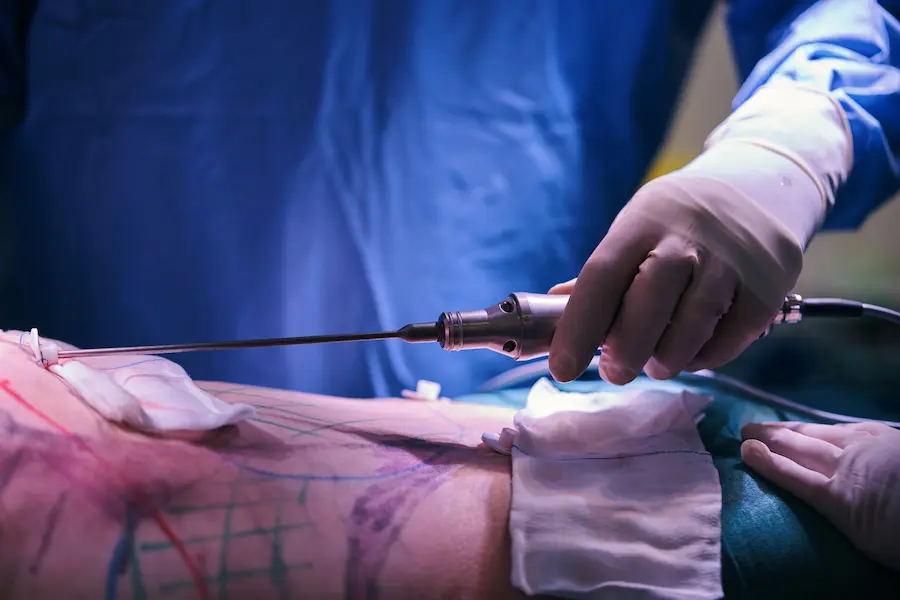 The High Definition Lipo Procedure