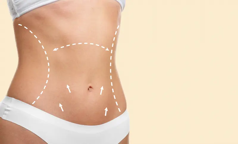 The Tummy Tuck Procedure