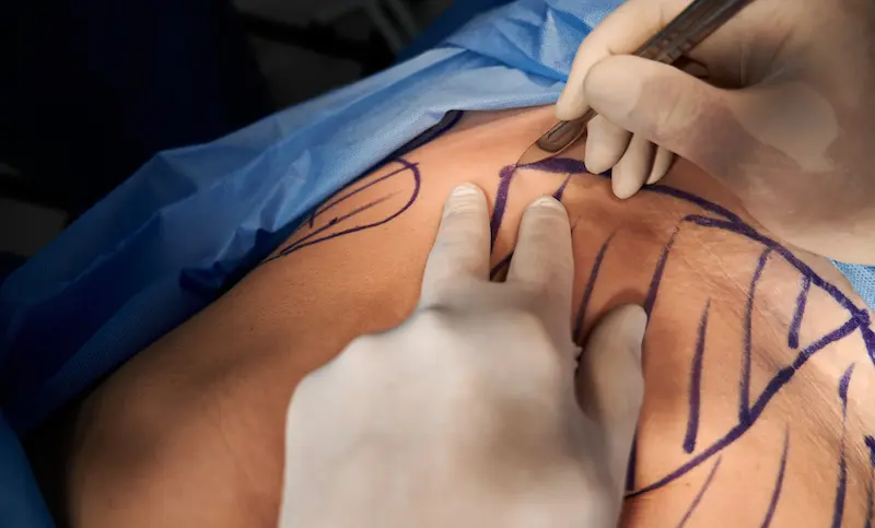 Tummy Tuck (Abdominoplasty) in Turkey
