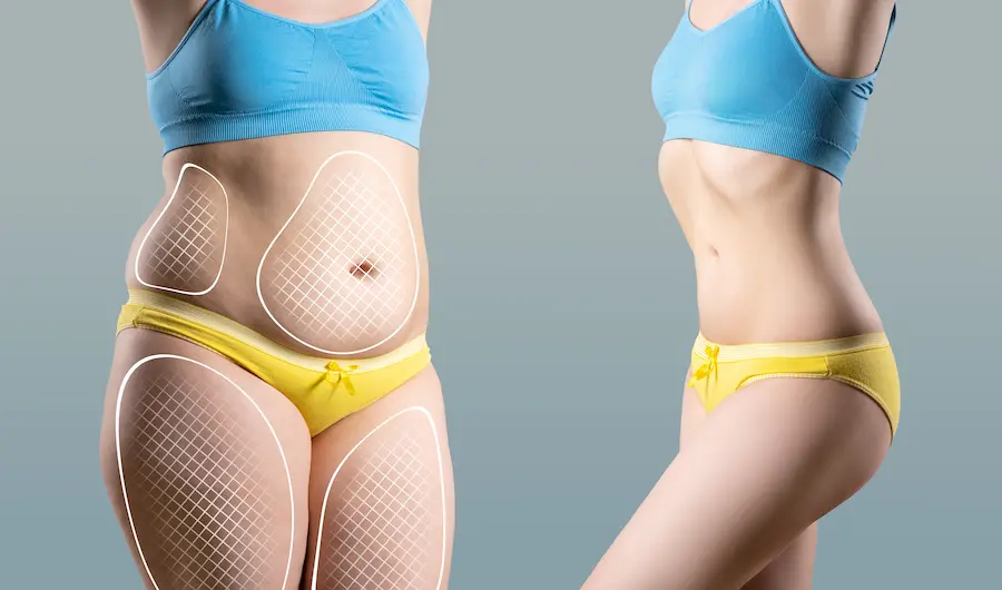 Vaser Liposuction
