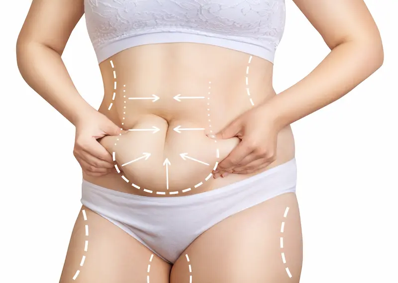 Who is an Ideal Candidate for VASER Liposuction?