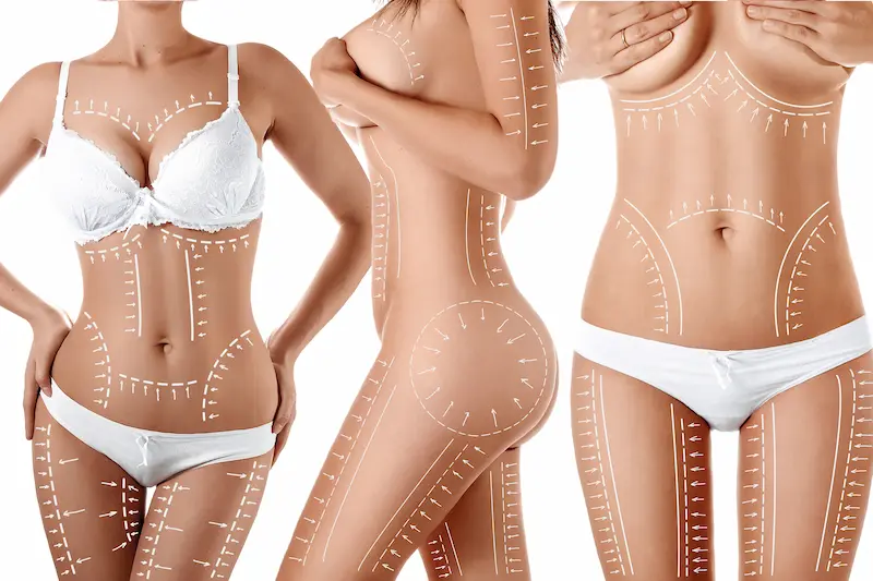 What is J Plasma Liposuction